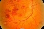 Diabetic Retinopathy, Virginia <b>Retina</b> Foundation