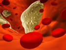 <b>Coronary arteriosclerosis</b>