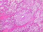 <b>Adenoma</b> cromófobo e áreas