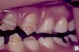 <b>Hipoplasia</b> del <b>esmalte</b>.