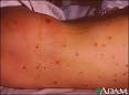 <b>Meningococcal infections</b>.