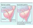 <b>Prostatitis</b> symptoms include: