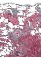 Hypersensitivity pneumonitis - Wikipedia, the free encyclopedia