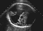 <b>Dandy</b>-<b>Walker syndrome</b>