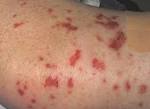 <b>Churg</b>-<b>Strauss Syndrome</b> is one