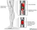 Arterial embolism: MedlinePlus Medical Encyclopedia Image