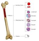 <b>bone marrow</b> transplant.