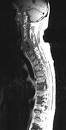 Spinal Cord Cancer (Lymphoma of the Spinal Cord)