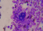 File:Blastomycosis cropped.JPG - Wikipedia, the free encyclopedia