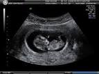 The Hendon Clinic - Dating & Fetal Viability