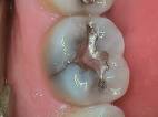 <b>Cracked Tooth Syndrome</b>
