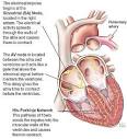 Arrhythmia