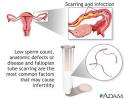 <b>Infertility</b> scarring