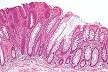 <b>adenoma</b> (left of image),