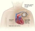 How Can Death Due to Sudden Cardiac Arrest Be Prevented? - NHLBI, NIH