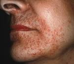A case of granulomatous rosacea: Sorting granulomatous rosacea ...
