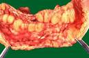 New Treatment Scheme For Crohn's Disease Changes The Outcomes