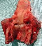 cancer du <b>larynx</b> - Forum