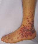 File:<b>Vasculitis</b>.JPG