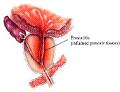 acute <b>prostatitis</b> information