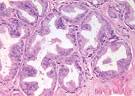 Modern Pathology - Figure 13 for article: Diagnosis and reporting