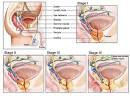 Urination - painful. Causes, symptoms, treatment Urination - painful