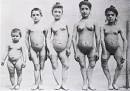 Five children with <b>rickets</b>,