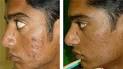 Pitting acne: 2 wks following