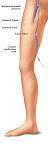 Endovenous Laser Therapy For Varicose Veins - Vein Treatment ...