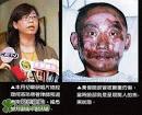 Gee, I didn't know Jen Chia Hsuan burn was this bad. - 001ec9502df60e764a3a0e