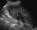 a swallowed <b>foreign body</b>