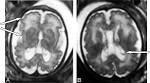 of <b>Zellweger Syndrome</b>