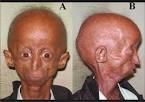 alopecia with grey and