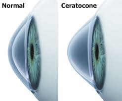 Ceratocone, ectasia, ectasia corneal, ectasia corneana, tratamento para ceratocone, cura para ceratocone, ceratocone avançado, ceratocone inicial, suspeita de ceratocone, lente para ceratocone, especialista em ceratocone, especialista ceratocone porto alegre, clinica especializada em ceratocone, oftalmologista ceratocone, oftalmologista para ceratocone, especializado em ceratocone, cone, córnea fina, cornea fina, córnea em forma de cone, cornea em forma de cone, ceratocone tratamento, ceratocone cirurgia, crosslink, cross link, crosslinking, cross linking, anel de ferrara, transplante de córnea, transplante de cornea