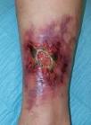 <b>pyoderma gangrenosum</b>