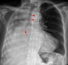 Linear scarring or <b>atelectasis</b>