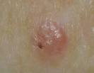 carcinoma