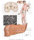 III - Wilson <b>Disease</b>