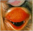 <b>Tracoma</b>. Fonte: OMS. DEFINIÇÃO