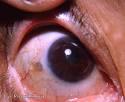 Category: External <b>Disease</b>