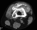 <b>Osteolysis</b> and metallosis in a
