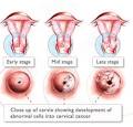 Cervical Cancer Prevention | cancer car donation