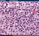 numbers of <b>histiocytes</b>,