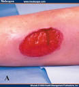 Two Cases of Traumatic Wounds in Ehlers-Danlos Syndrome Patients ...
