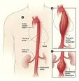 Symptoms of Aortic Aneurysms