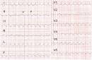 <b>TAQUICARDIA</b> VENTRICULAR.