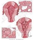 Endometrial Hyperplasia and Polyps, Tuberculous Endometritis ...