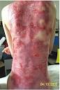 Epidermolysis Bullosa - types