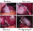 Cholecystectomy - Wikipedia, the free encyclopedia