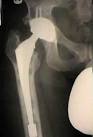 mechanism of <b>osteolysis</b>: